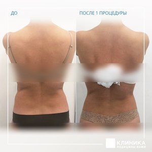 Криолипосакция