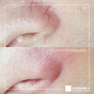 Лазерное удаление сосудов