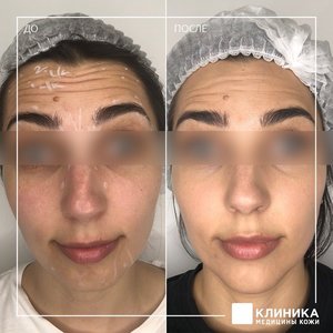 Ботулинотерапия
